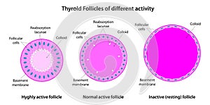 Thyroid Follicles of different activity: hyghly, normal and inactive.