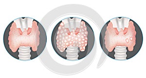 Thyroid gland diseases.