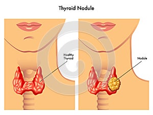 Thyroid nodule