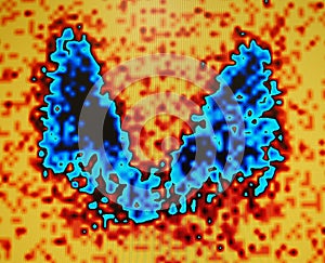 thyroid nuclear medicine