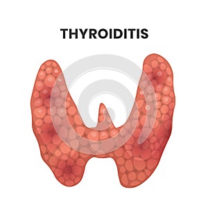 Thyroiditis illustration. vector illustration of the inflamed thyroid gland