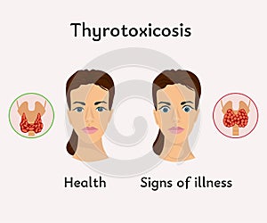 thyrotoxicosis thyroid gland medical poster