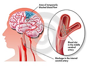 TIA (transient ischemic attack)