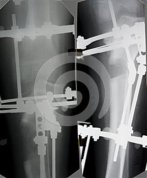 Tibia x-ray picture photo