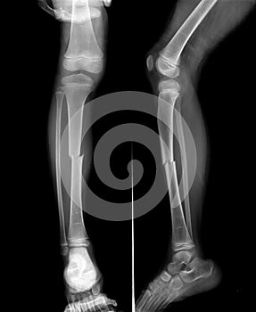 Tibial fracture at mid shaft of the bone.
