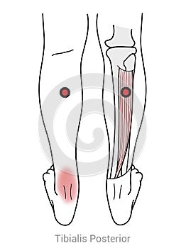 Tibialis Posterior: Managing pain arriving from Myofascial trigger points in the calf muscles