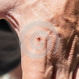 tick bit human hand. Ixodes ricinus. Parasitic mite. Acarus. Dangerous insect mite. Encephalit, Lyme disease infection photo