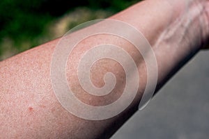 Tick bite on the arm of a woman