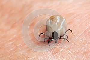 A tick drunk on blood crawls on human skin