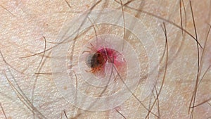 Tick embedded in human skin causing