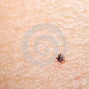 Tick feeding on human skin, macro