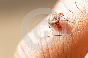 Tick filled with blood on human skin