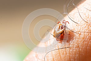 Tick filled with blood on human skin