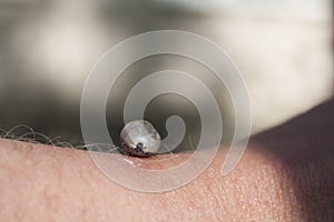 Tick on hand