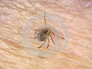 Tick on human hairy skin