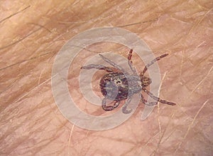 Tick on human hairy skin background