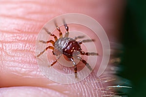 A tick on human skin. Transmission of dangerous infectious diseases. Generative AI