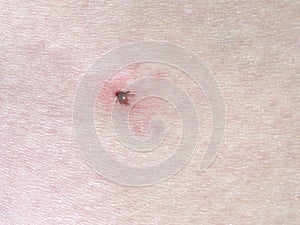 Tick, Insect, Bug Bite, Parasite