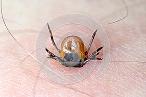 Tick with its chelicerae sticking in human skin.