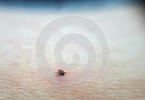 Tick Ixodes ricinus on human skin.