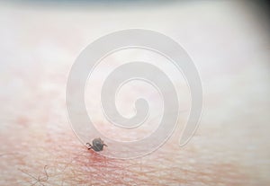 Tick Ixodes ricinus on human skin.