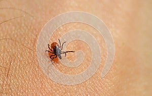 Tick  Ixodes ricinus  on human skin.