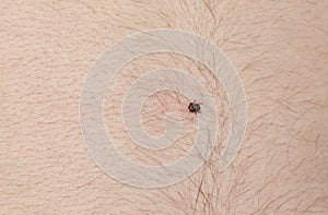 The tick of Ixodidae sits on the belly of a man during a walk