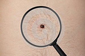 tick is sitting on the skin of a man, and magnified under a magnifying glass.