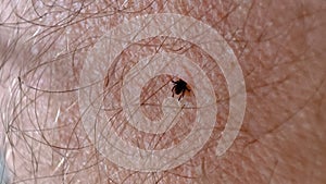 tick sucking blood on human skin close-up