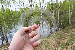 Ticks on the finger of man photo