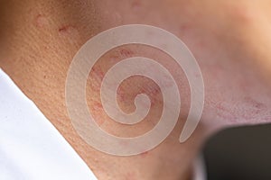 Tinea circinata or ringworm .