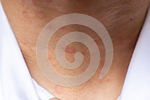 Tinea circinata or ringworm .