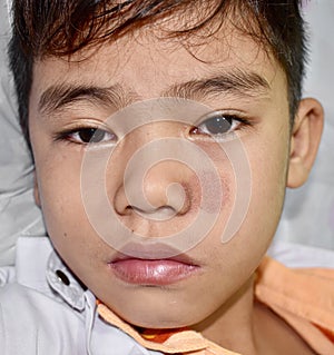 Tinea faciei or Fungal Infection on face of Asian two years old child