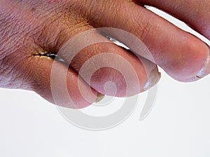 Tinea between the toes