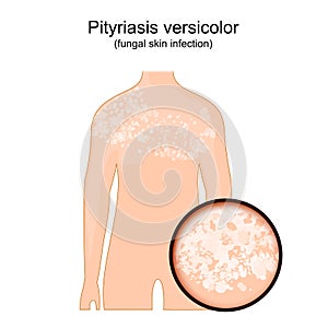 Tinea versicolor. Human body with symptoms of pityriasis versicolor