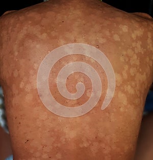 Tinea versicolor, Pityriasis versicolor skin infection on the back is a type of fungal disease caused by Malassezia spp., photo