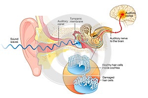 Tinnitus. Damaged hair cells inside cochlea