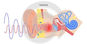 Tinnitus disease concept photo
