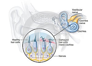 Tinnitus, healthy and damaged hair cells inside cochlea, medical illustration