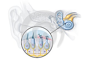 Tinnitus, healthy and damaged hair cells inside cochlea, medical illustration