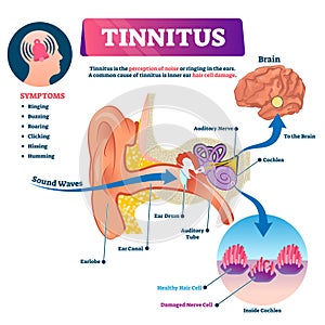 Tinnitus vector illustration. Labeled shingles noise perception ear problem photo