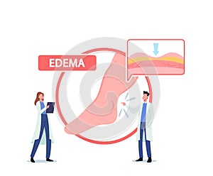 Tiny Doctor Characters Presenting Huge Infographics with Patient Diseased Legs, Medical Concept of Edema, Lymphedema