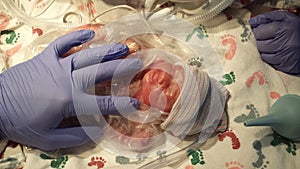 Tiny preemie baby girl moments after she was born