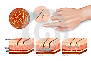 Tissue injury and inflammation.