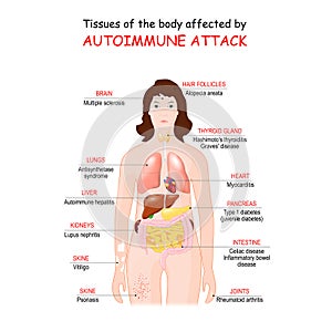 Tissues of the body affected by autoimmune attack
