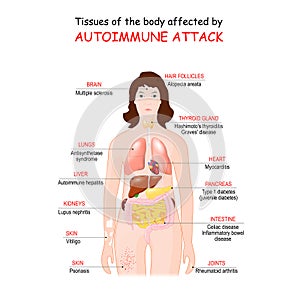 Tissues of the body affected by autoimmune attack