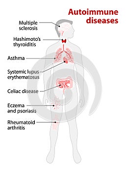 Tissues of the human body affected by autoimmune attack photo