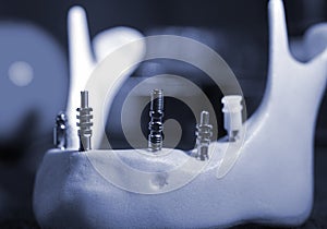 Titanium abutments in the artificial jawbone close-up.