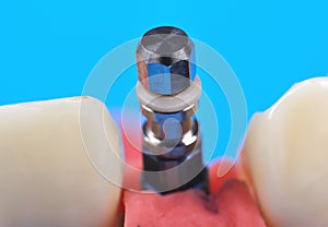 Titanium implant