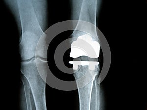 Titanium Knee photo